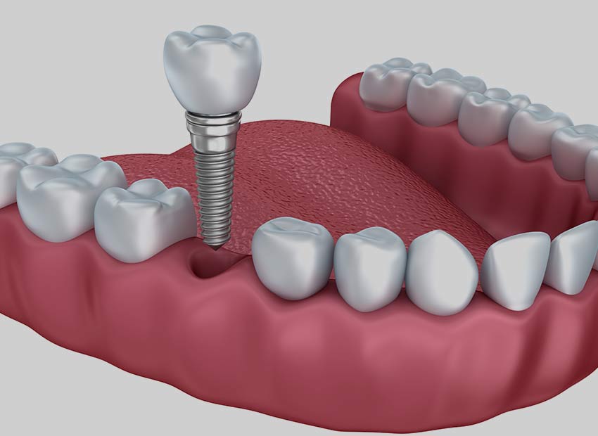 Dental Implants