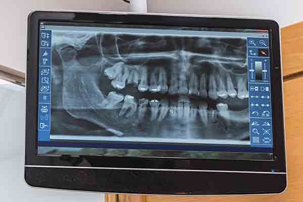 Digital Dental X-Rays Delaware