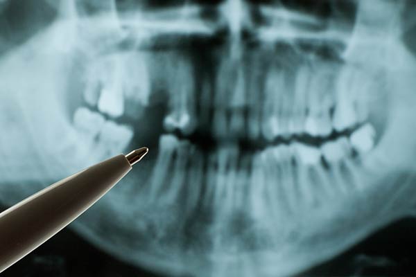 Extractions Due to Periodontal Disease