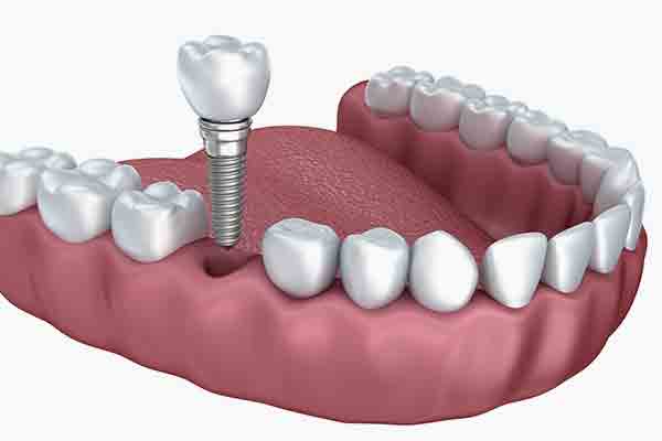 Best Dentail Implants Delaware