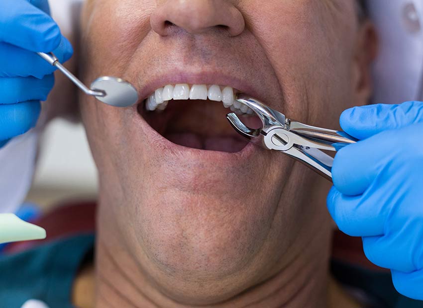 Decayed Tooth Tooth Extraction