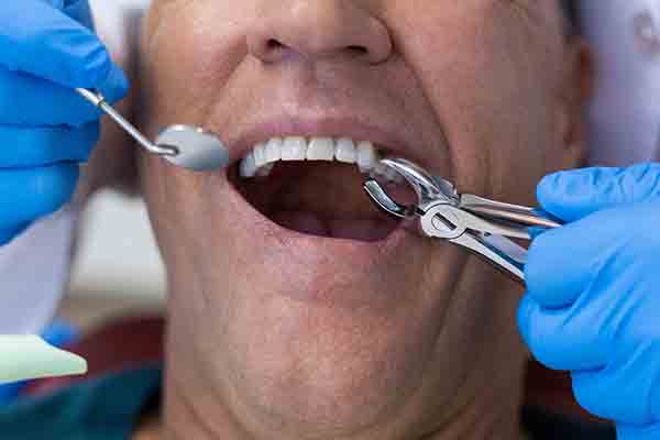 Decayed Tooth Tooth Extraction