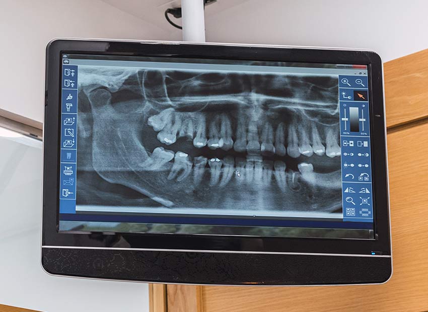 Digital Dental X-Rays