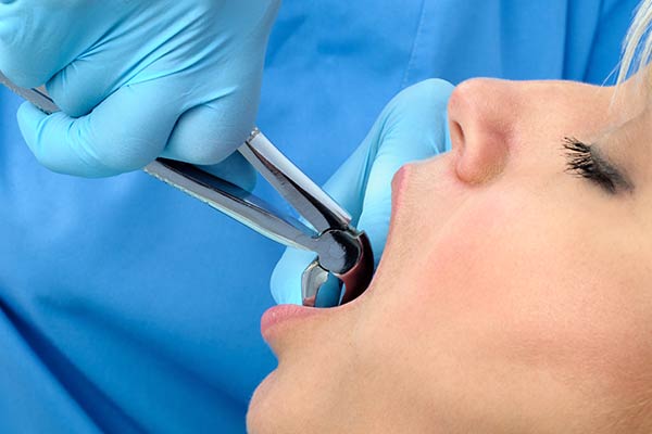 Fractured Root Canal Tooth Extraction