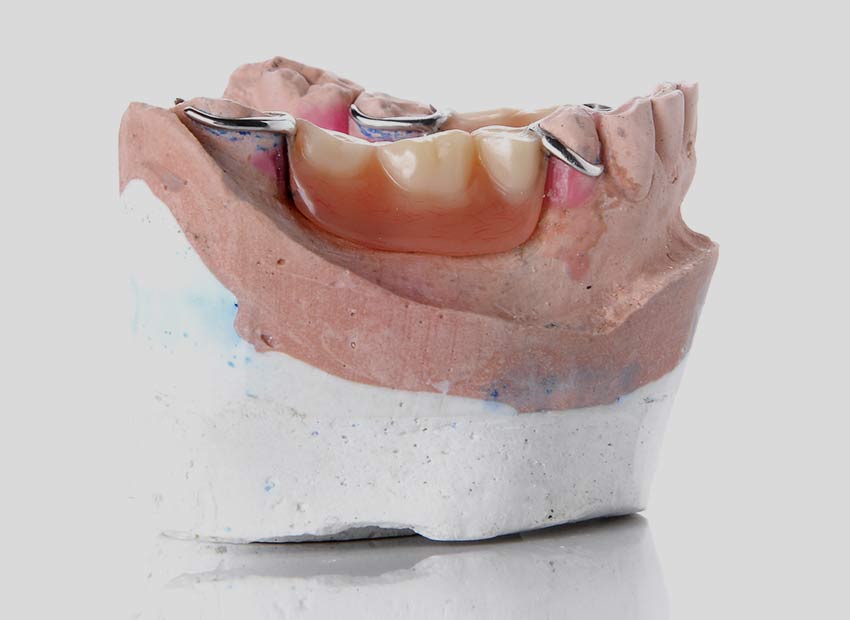 Partial Dentures