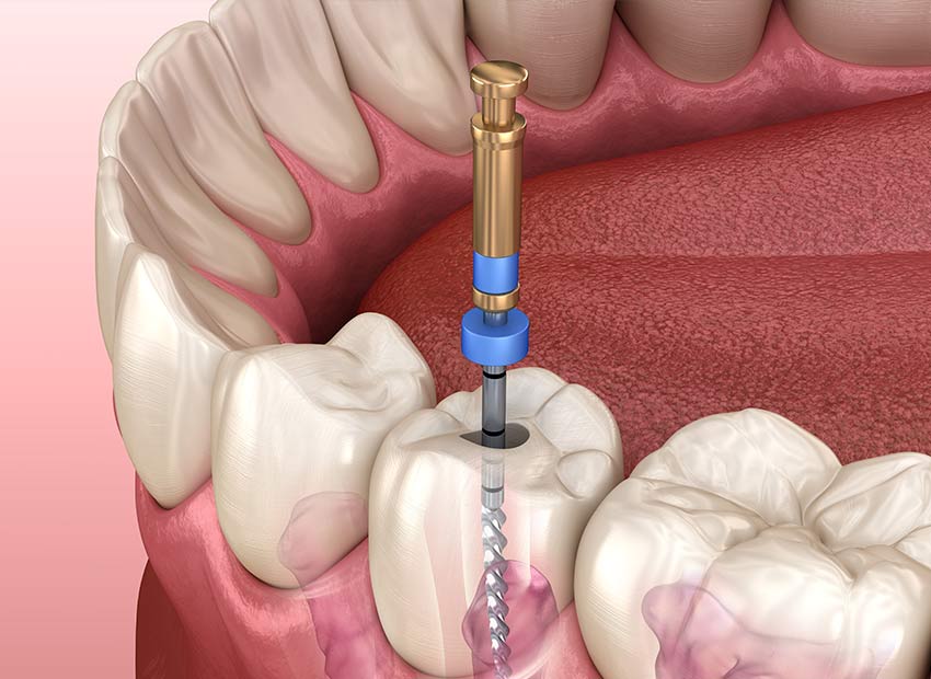 Root Canal Therapy