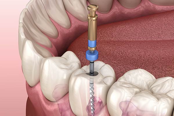 Root Canal Therapy