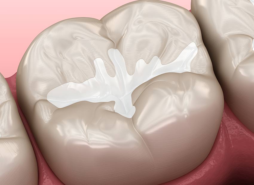 Teeth Sealants