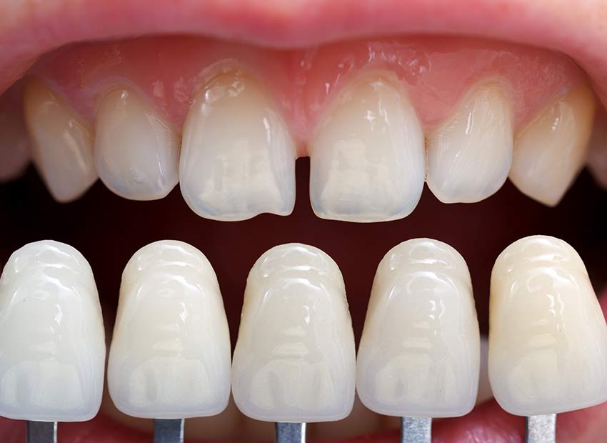 Teeth Veneers